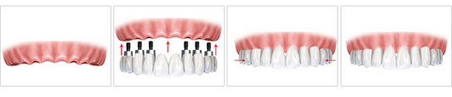全口种植牙有哪些优点?